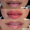 healed-dark-lip-pmu-600x600 Evenflo Neutralizer Set