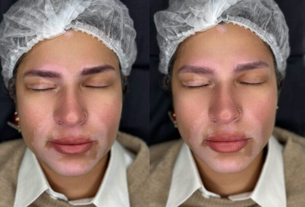 Hanafy Acid REMOVER Nº2