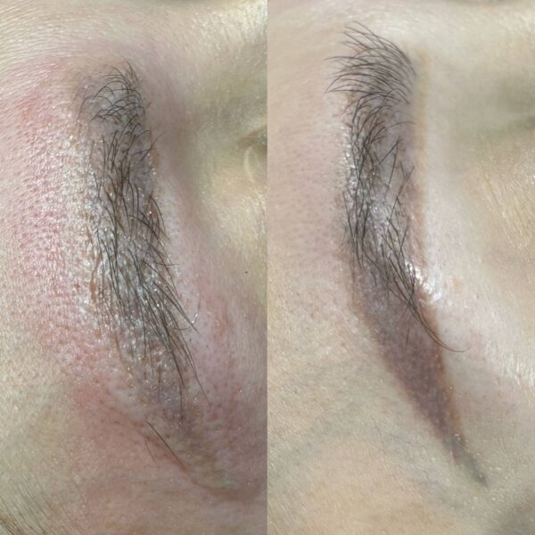 Hanafy Acid REMOVER Nº2